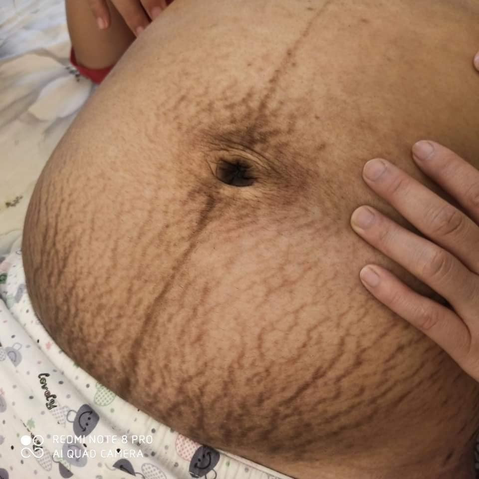 Cách giảm mỡ bụng sau sinh