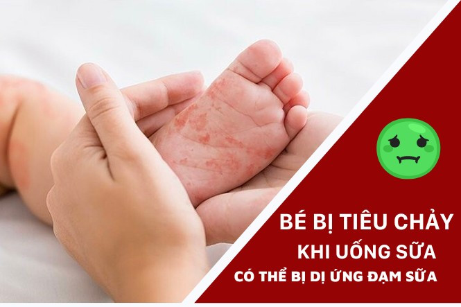 Bé uống sữa công thức bị tiêu chảy có phải bất dung nạp lactose?