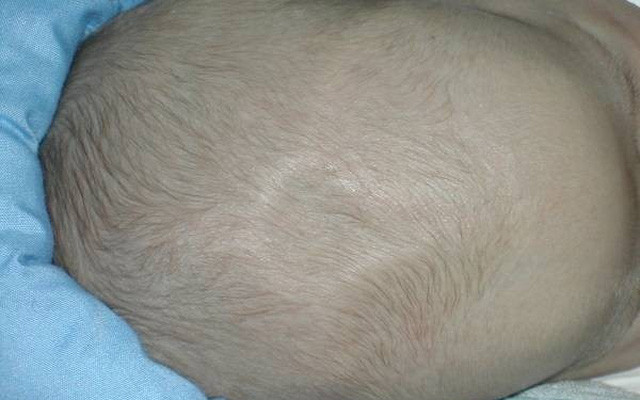 Sự phát triển bình thường của thóp trẻ sơ sinh